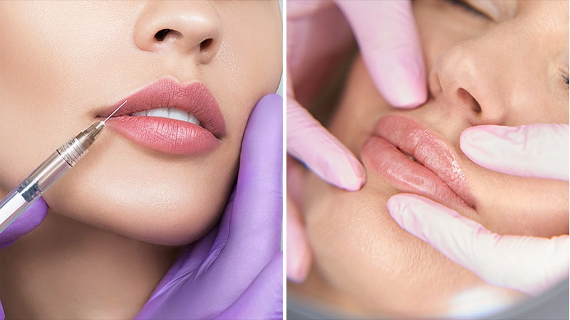 Lip Lift vs. Lip Fillers